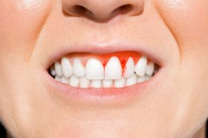 gingivitis bleeding gums