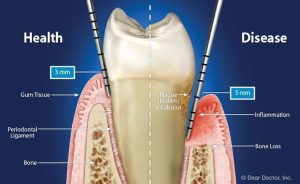 Periodontitis - periodontal pocket